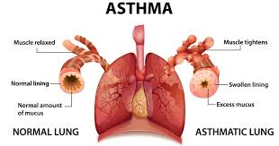 Asthma